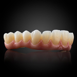 Phục Hình Thẩm Mỹ Toàn Hàm Trên Implant