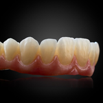 Phục Hình Thẩm Mỹ Toàn Hàm Trên Implant