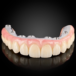 Phục Hình Toàn Hàm Trên Implant
