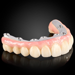 Phục Hình Toàn Hàm Trên Implant