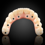 Phục Hình Toàn Hàm Trên Implant