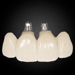 Phục Hình Cầu Và Mão Lẻ Trên Implant