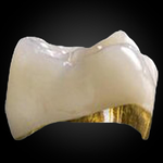PFM Restoration