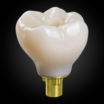 Phục Hình Bắt Vít Trên Implant