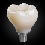 Phục Hình Bắt Vít Trên Implant