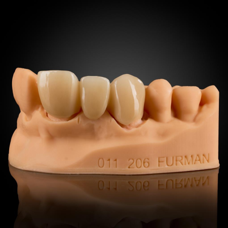Phục Hình Cut-Back Zirconia Phục Hình Cut-Back Zirconia