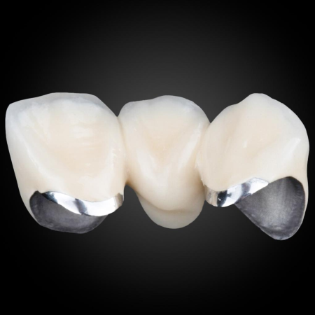 Phục Hình Sứ Kim Loại PFM Phục Hình Sứ Kim Loại PFM