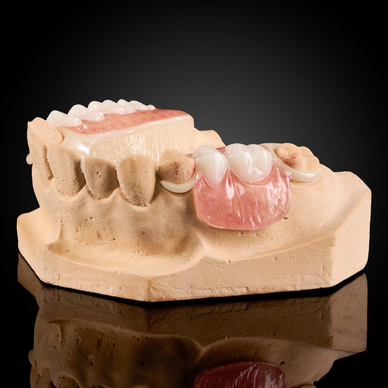 Phục Hình Tháo Lắp Bán Phần Khung Acetal