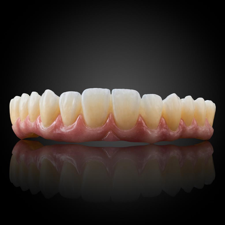 Phục Hình Thẩm Mỹ Toàn Hàm Trên Implant