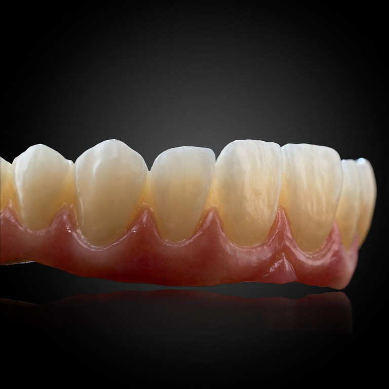 Phục Hình Thẩm Mỹ Toàn Hàm Trên Implant