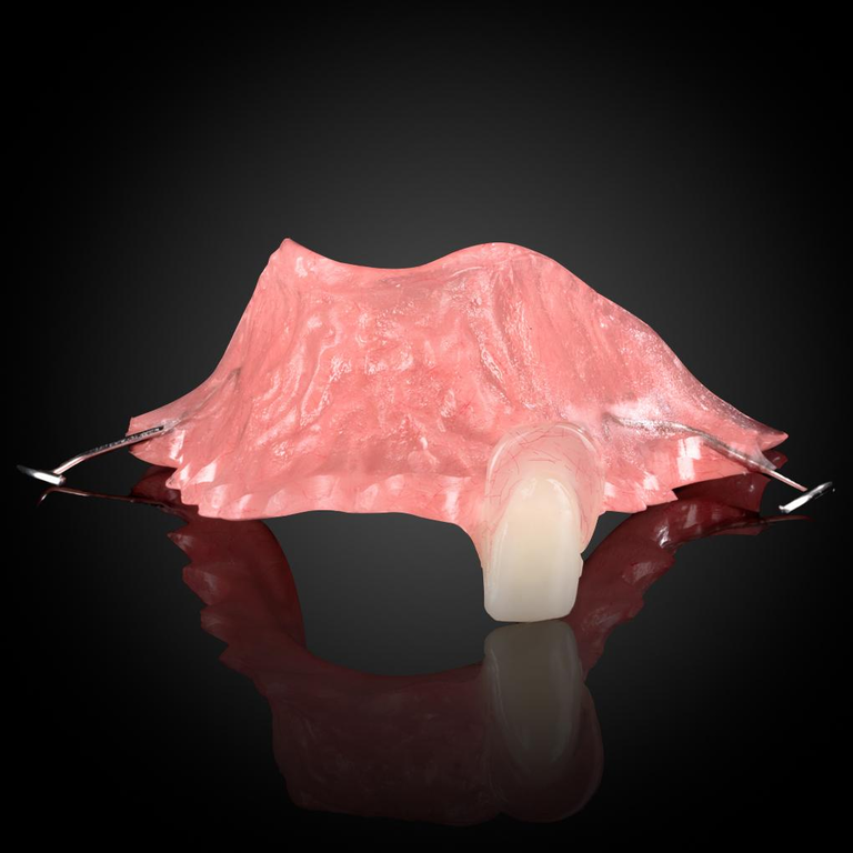 Phục Hình Tháo Lắp Tạm - 1 Răng
