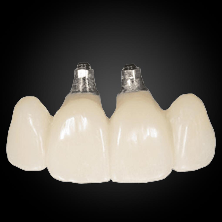 Phục Hình Cầu Và Mão Lẻ Trên Implant