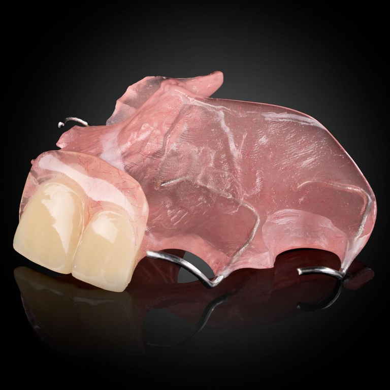 Phục Hình Tháo Lắp Tạm - Stay Plate