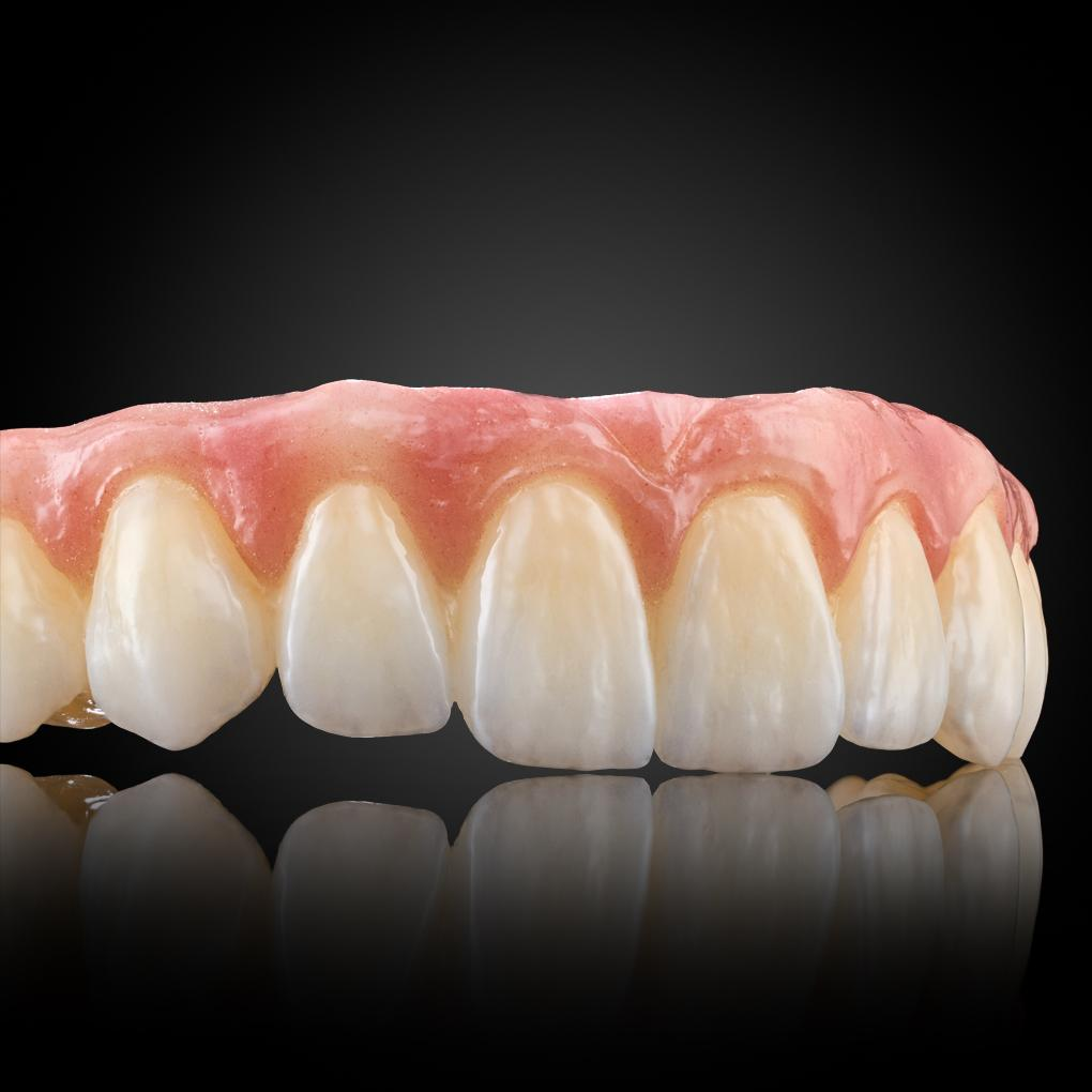 Phục Hình Thẩm Mỹ Toàn Hàm Trên Implant