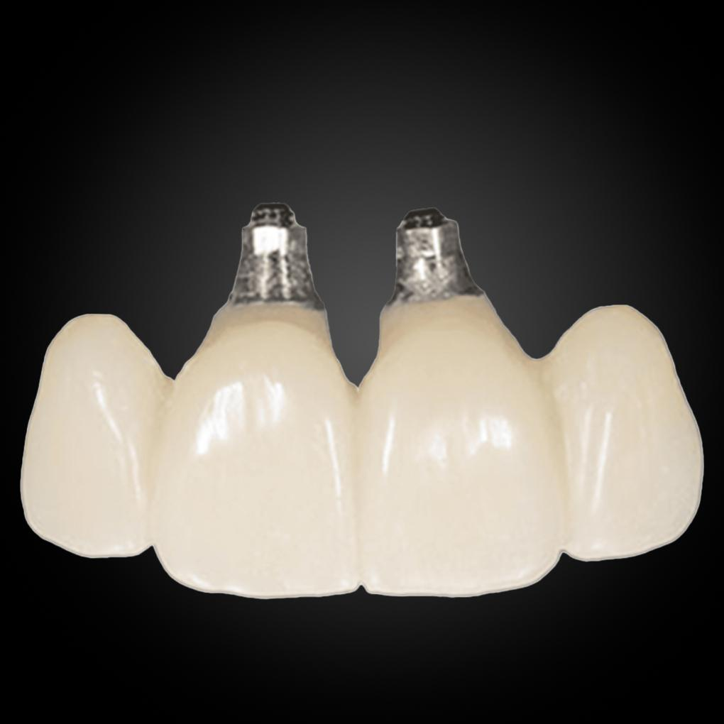 Phục Hình Cầu Và Mão Lẻ Trên Implant