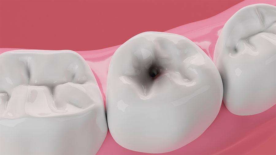 Sâu Mòn Men Răng: Nguyên Nhân, Điều Trị Và Phòng Ngừa