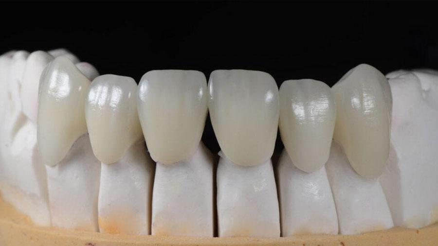 Cách Xử Lý Mão Zirconia Không Vừa Khít