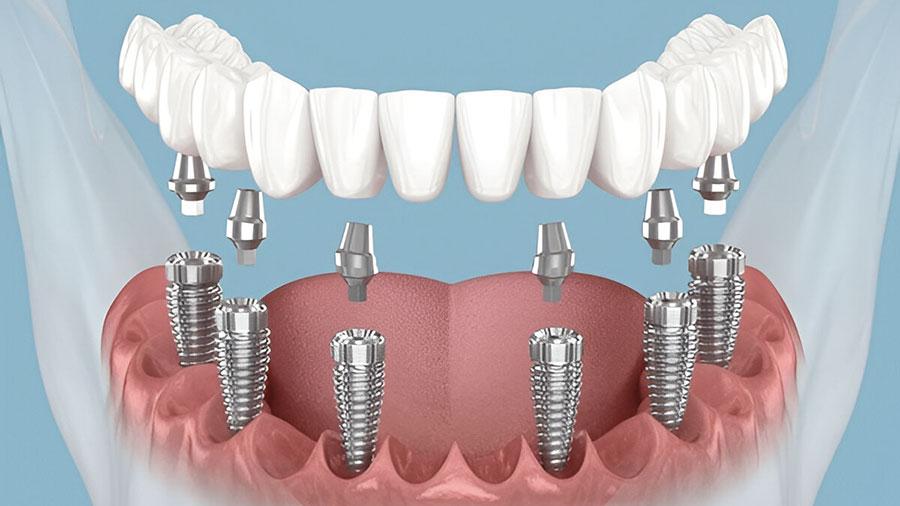 dental-lab-outsourcing-key-trends-for-2025