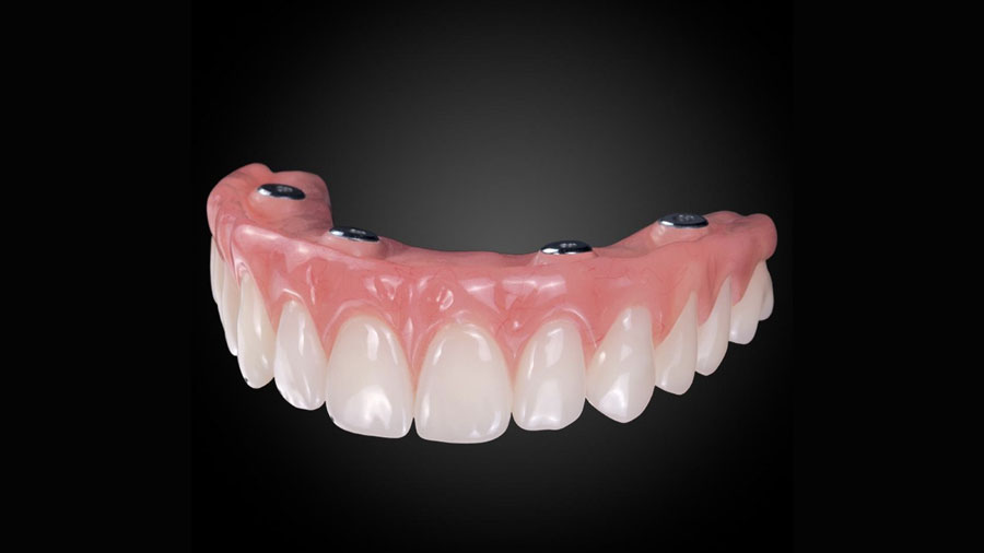 Exploring Polyetheretherketone (PEEK) In Dental Applications