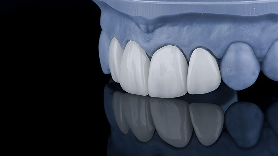 Glass-Infiltrated Alumina (In-Ceram Alumina): A Comprehensive Guide For Dental Professionals