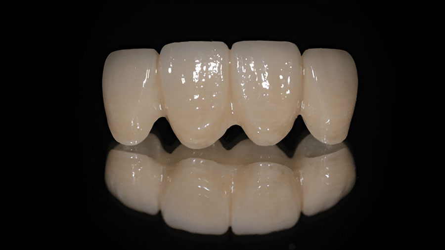 How Multi-Layered Zirconia Revolutionizes Dental Ceramic Frameworks