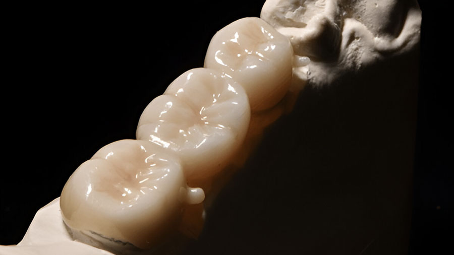 In-Ceram Zirconia: The Ultimate Guide To Glass-Infiltrated Zirconia-Reinforced Alumina