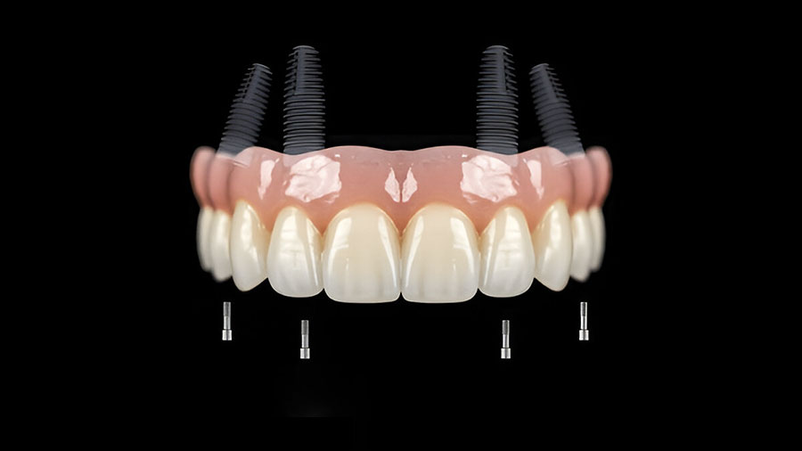 Polyetherketoneketone (PEKK): Revolutionizing Dental Prosthetics