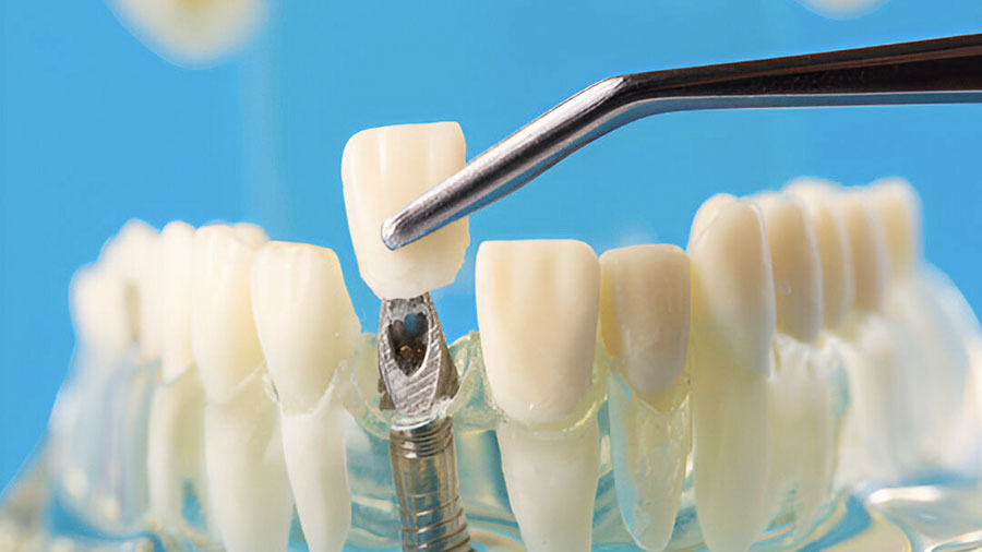Why Alumina Systems Are Still Relevant In Dental Restorations Today
